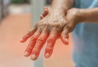 Peripheral Neuropathy