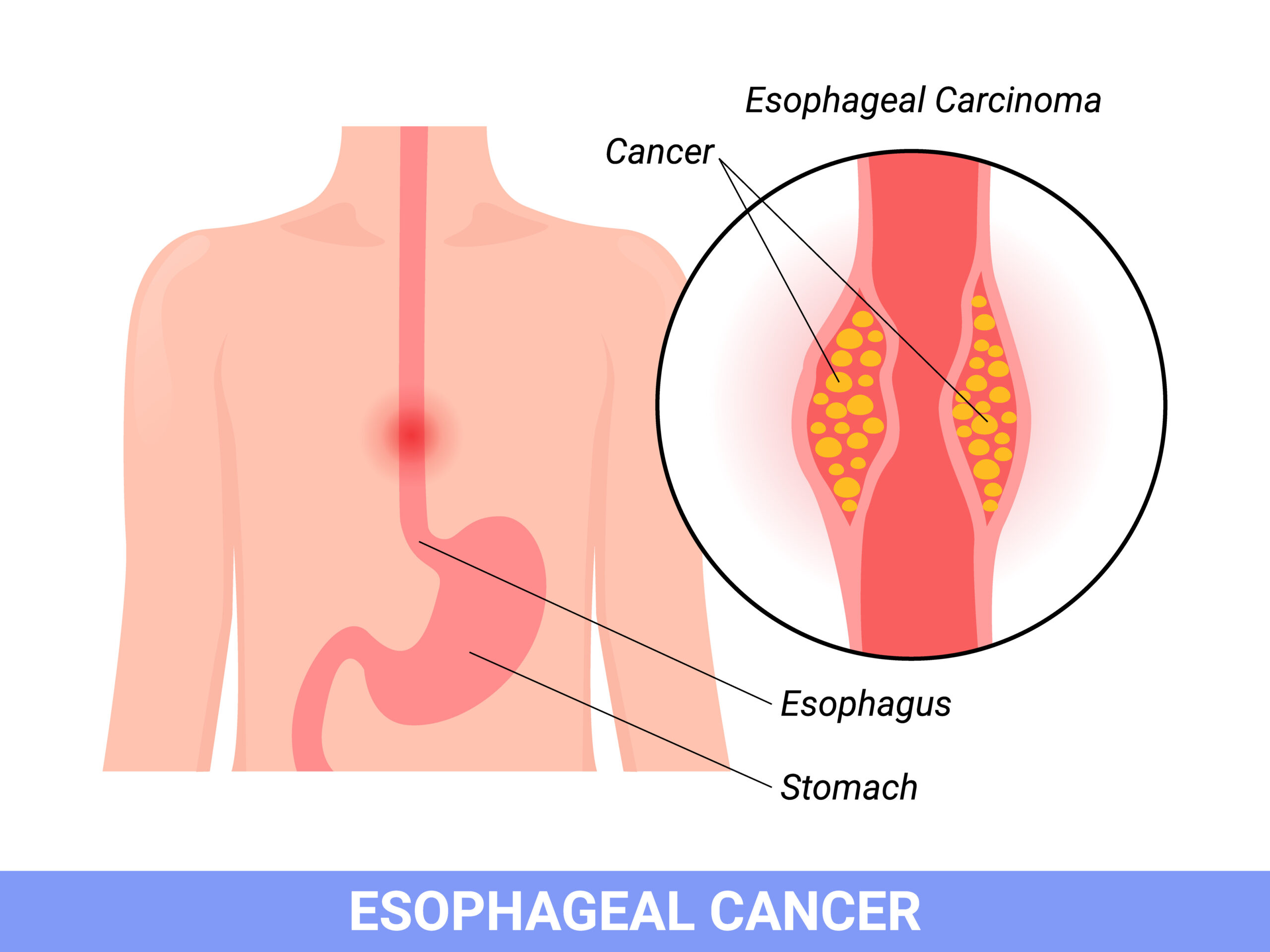 Esophageal cancer awareness and treatment