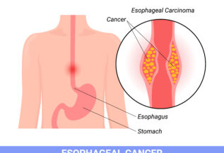 Esophageal Cancer; Causes Symptoms and Advanced Treatments