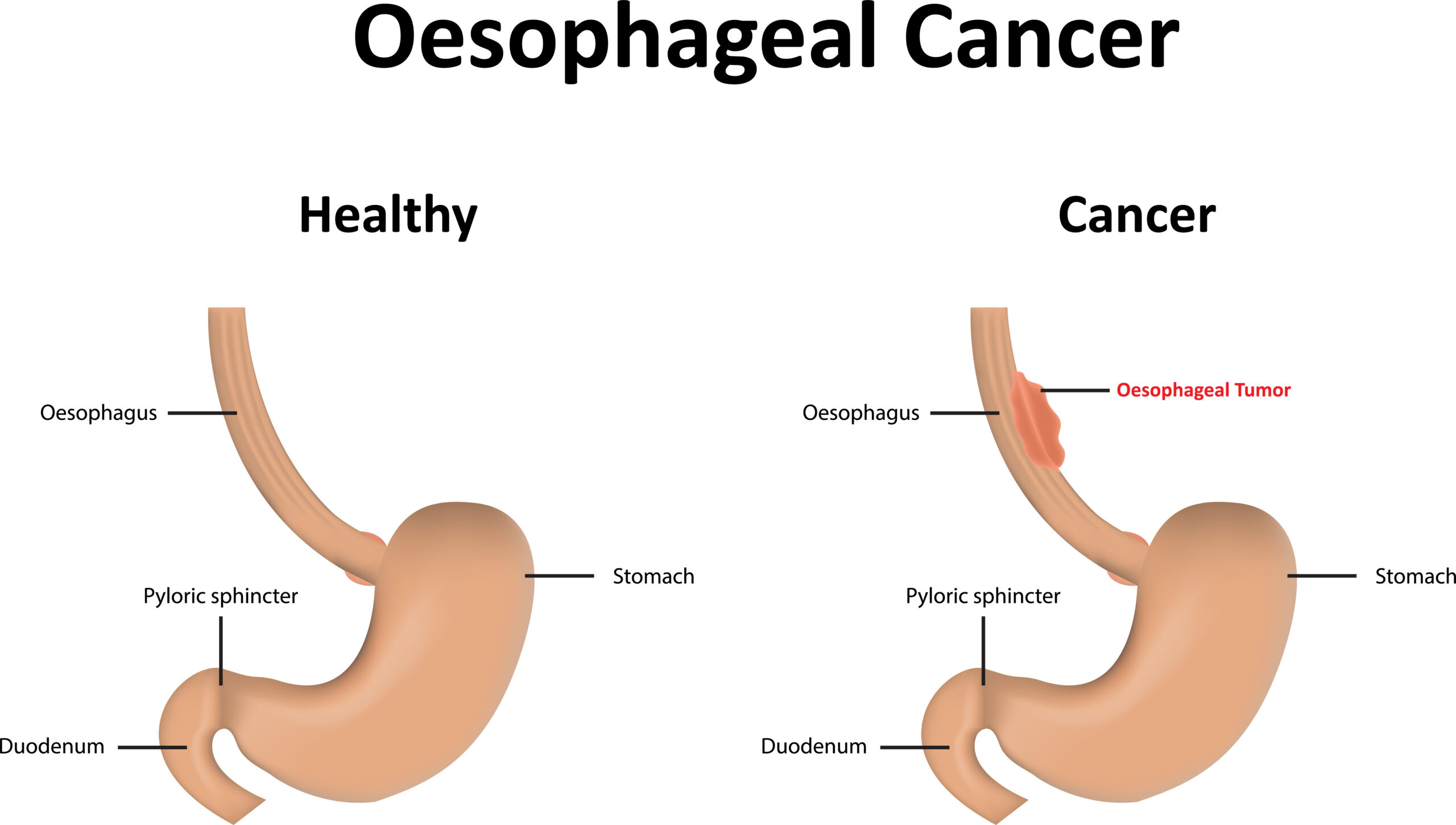 Esophageal cancer awareness and treatment