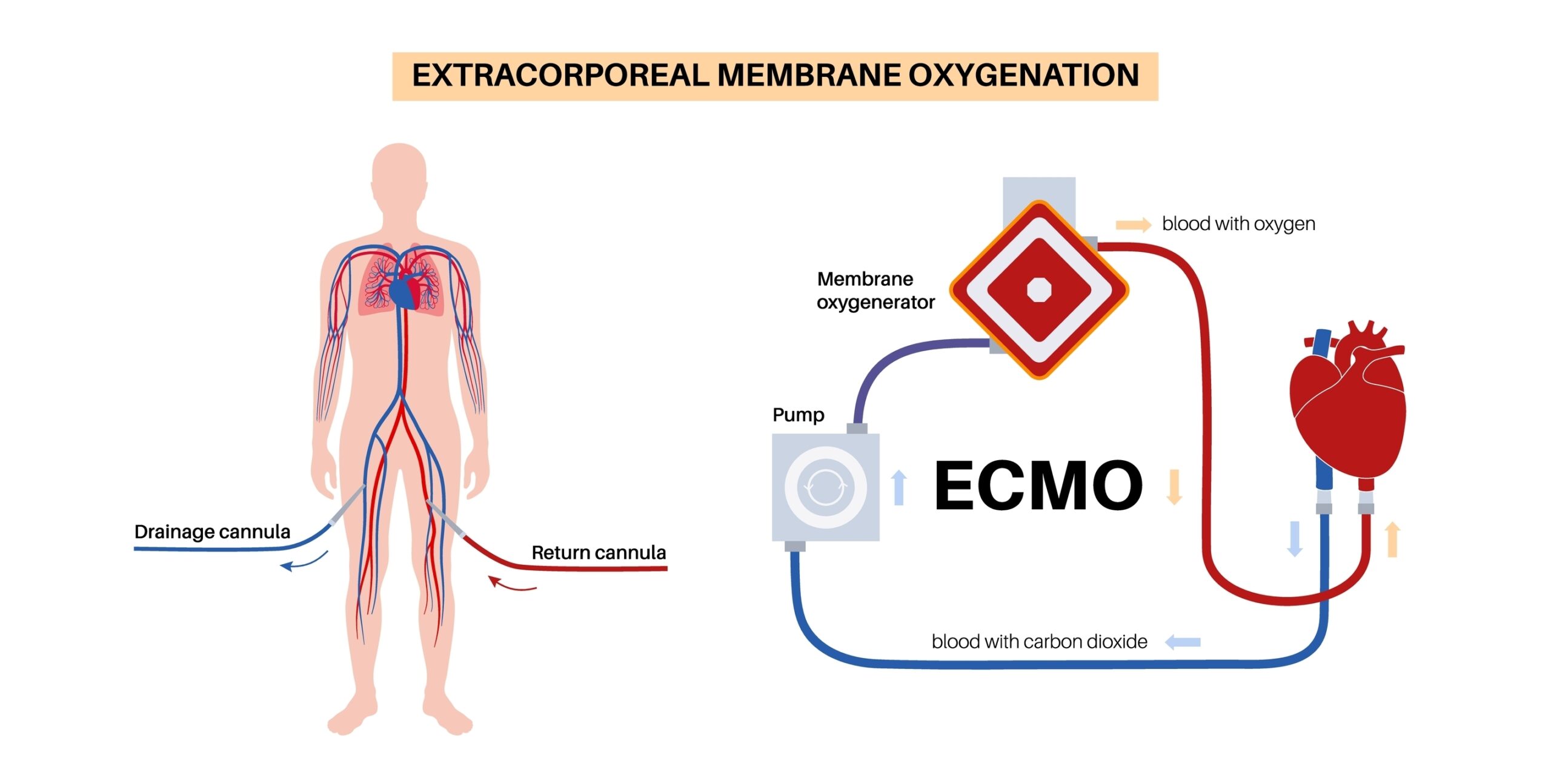 Extracorporeal,Membrane,Oxygenation,Ecmo,A,Life,Support,System,For,Respiratory