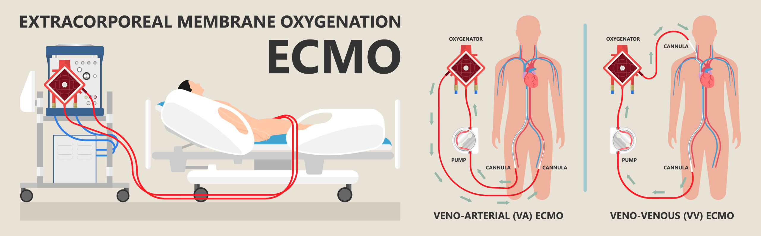 Extracorporeal,Membrane,Oxygenation,Ecmo,A,Life,Support,System,For,Respiratory