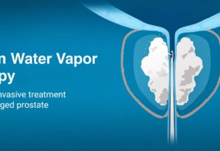 Rezūm Water Vapor Therapy: Treating Enlarged Prostate Without Major Surgery