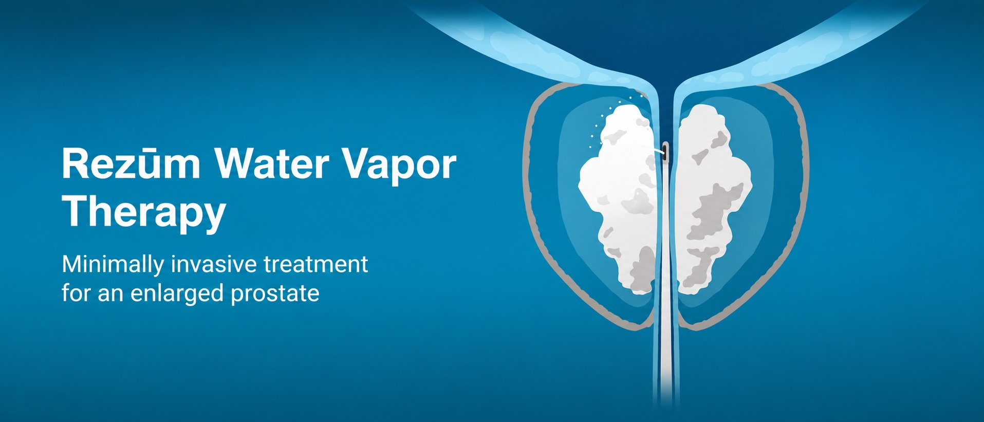 Rezūm Water Vapor Therapy: Treating Enlarged Prostate Without Major Surgery
